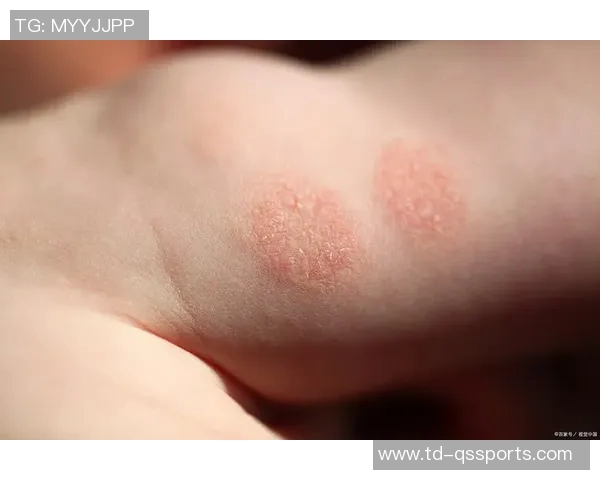 湿疹真相:起初,人们以为这只是一种普通的皮肤病,却未曾料到背后隐藏的秘密 湿疹真相:起初,人们以为这只是一种普通的皮肤病,却未曾料到背后隐藏的秘密